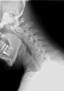 cervical xray extension