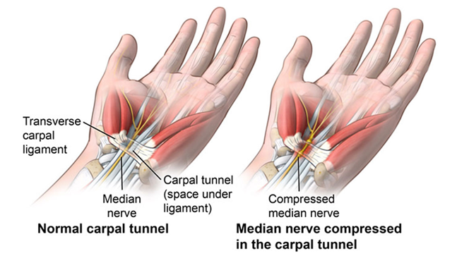 Natural Remedies for Carpal Tunnel Syndrome