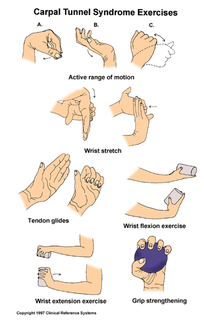 carpal tunnel syndrome exercises)