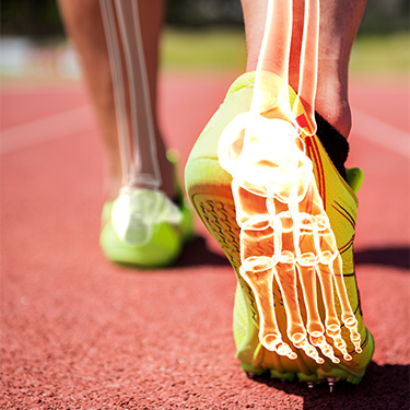 plantar fasciitis