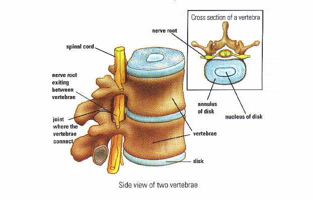 Degenerative Disc Disease - Side View of Two Vertebrae